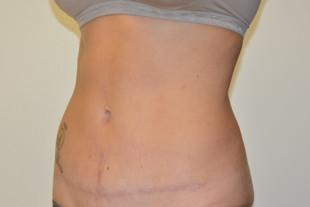 Tummy-Tuck-25 | After Tummy Tuck 2