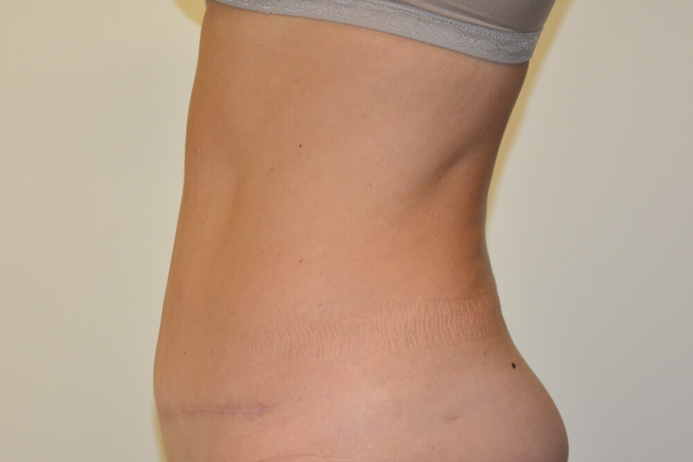 Tummy-Tuck-25 | After Tummy Tuck 3
