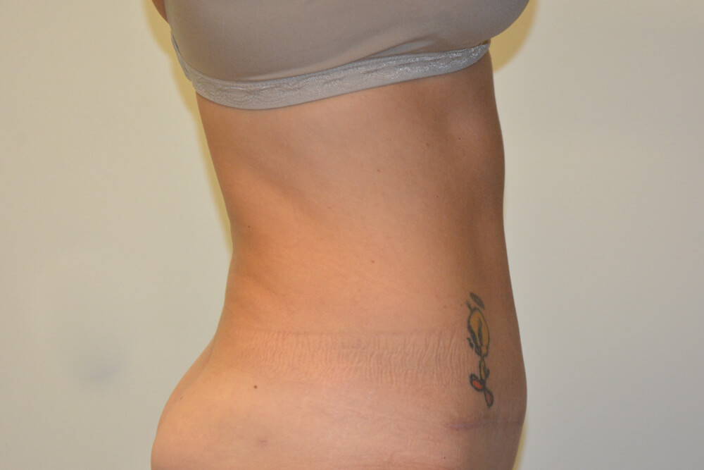 Tummy-Tuck-25 | After Tummy Tuck 4
