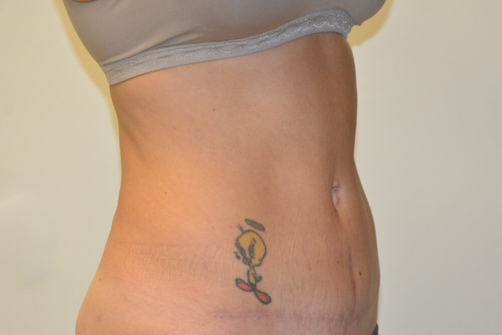 Tummy-Tuck-25 | After Tummy Tuck 5