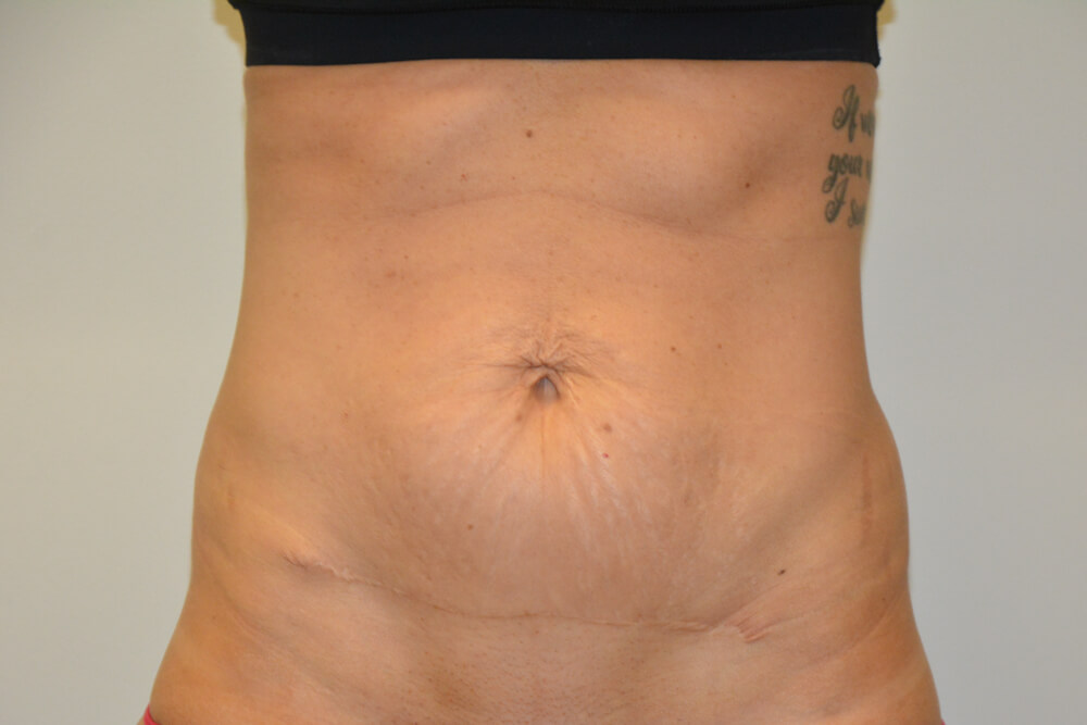 Tummy-Tuck-26 | Before Tummy Tuck