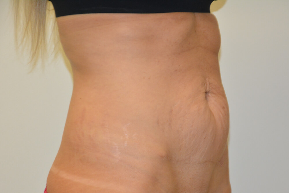 Tummy-Tuck-26 | Before Tummy Tuck 2