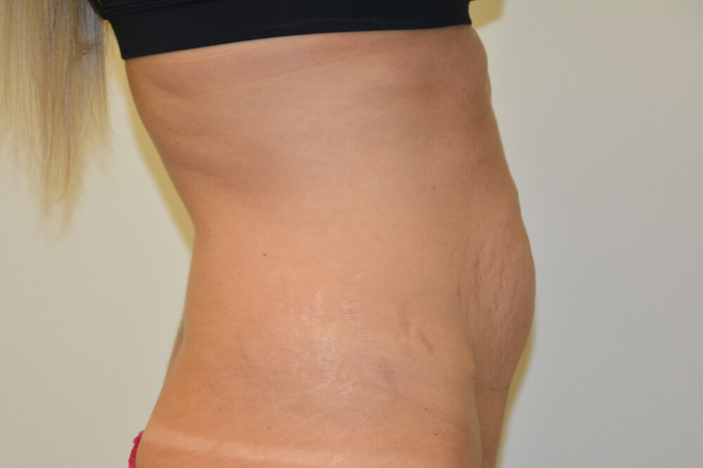 Tummy-Tuck-26 | Before Tummy Tuck 3