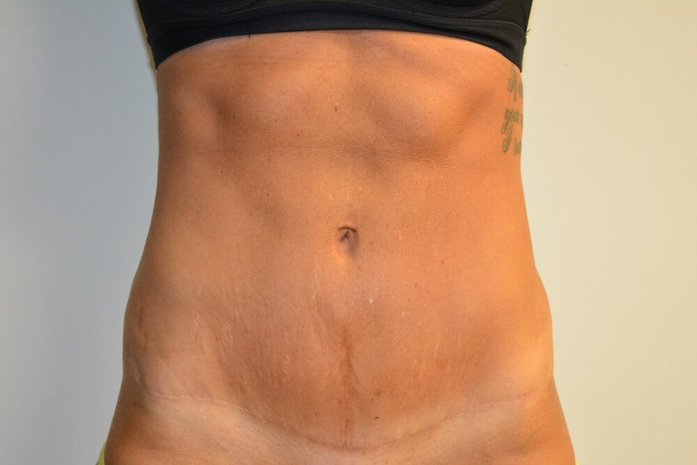 Tummy-Tuck-26 | After Tummy Tuck