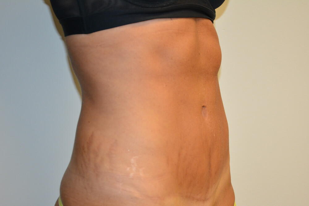 Tummy-Tuck-26 | After Tummy Tuck 2