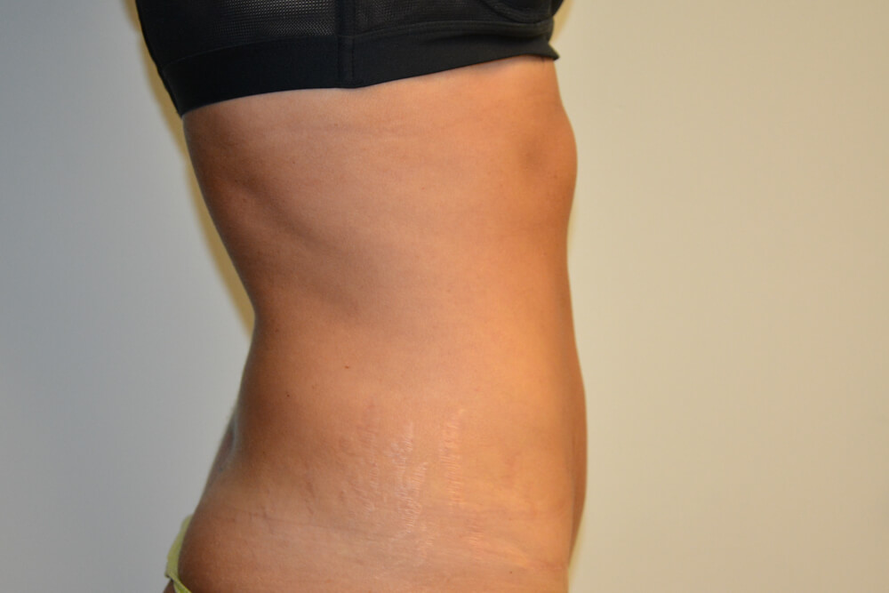 Tummy-Tuck-26 | After Tummy Tuck 3