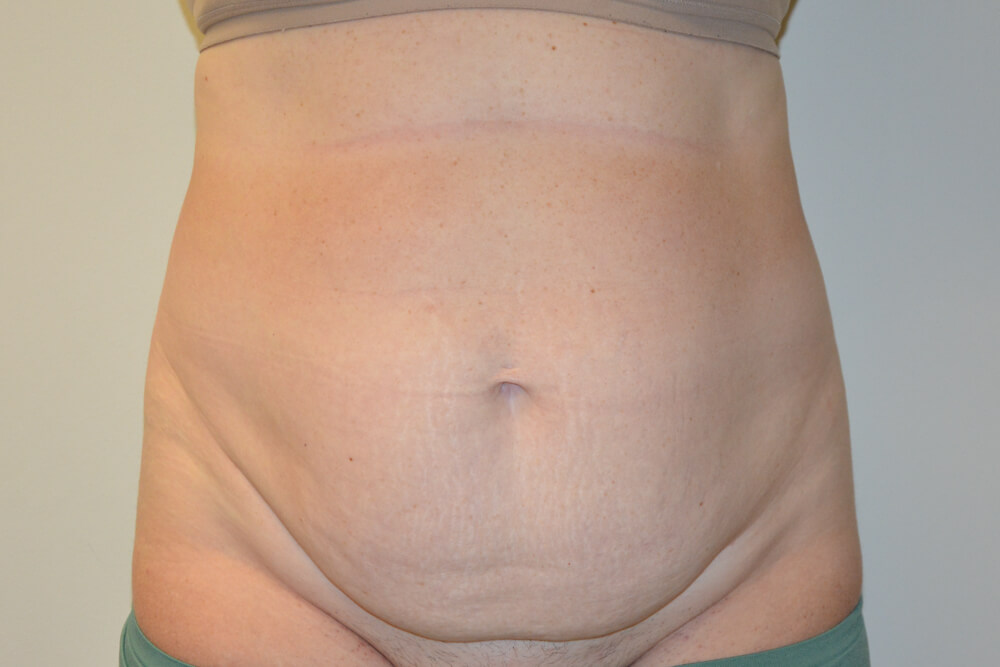 Tummy-Tuck-27 | Before Tummy Tuck