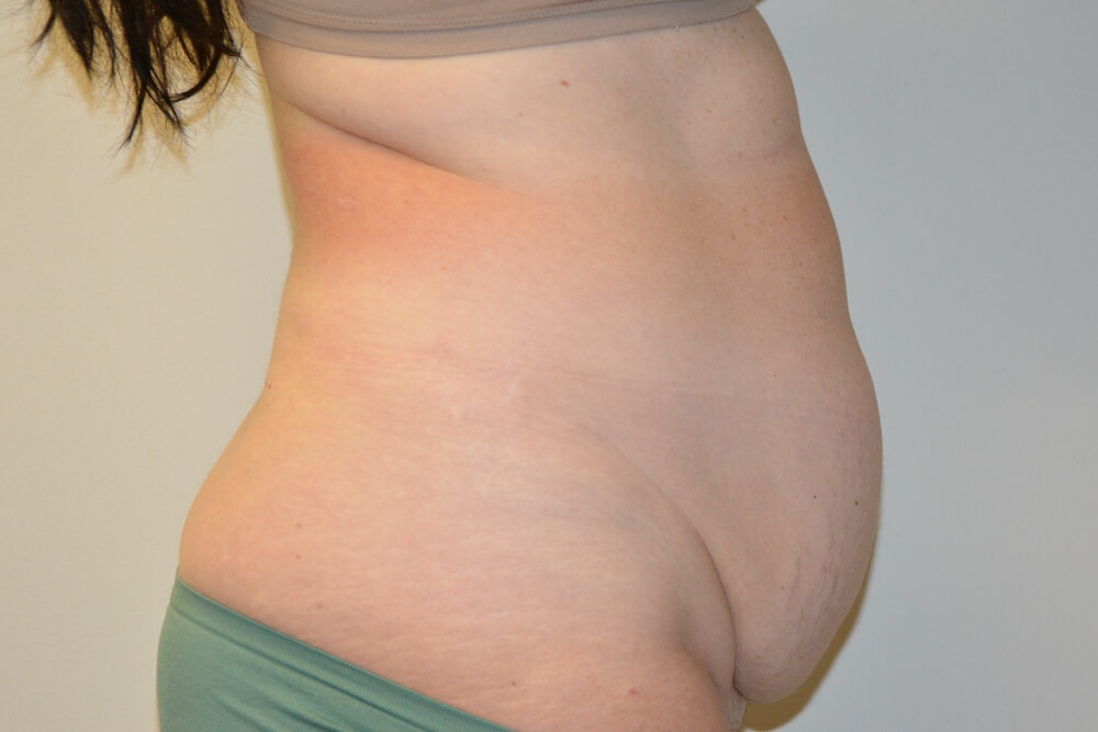 Tummy-Tuck-27 | Before Tummy Tuck 2