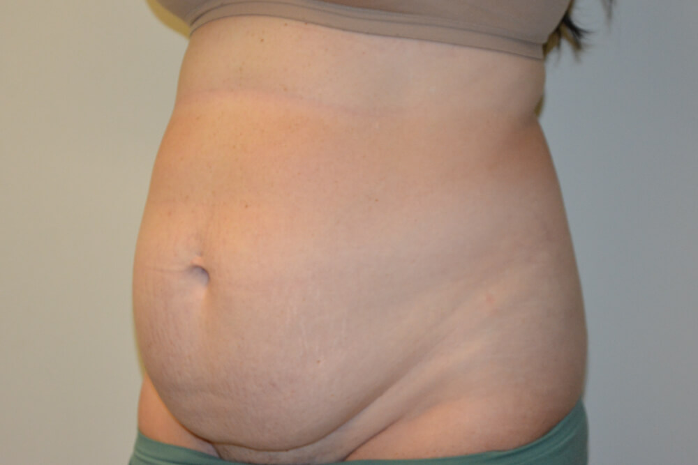 Tummy-Tuck-27 | Before Tummy Tuck 3