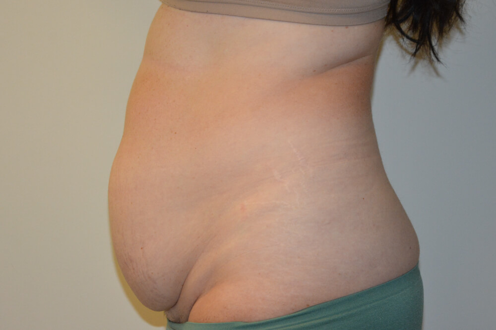 Tummy-Tuck-27 | Before Tummy Tuck 4