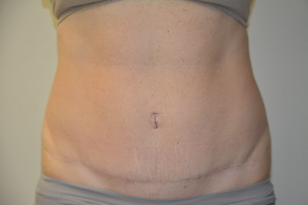 Tummy-Tuck-27 | After Tummy Tuck