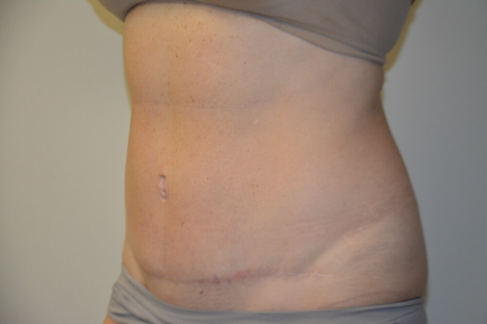 Tummy-Tuck-27 | After Tummy Tuck 3