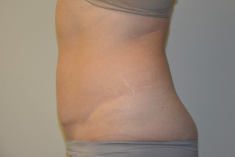 Tummy-Tuck-27 | After Tummy Tuck 4