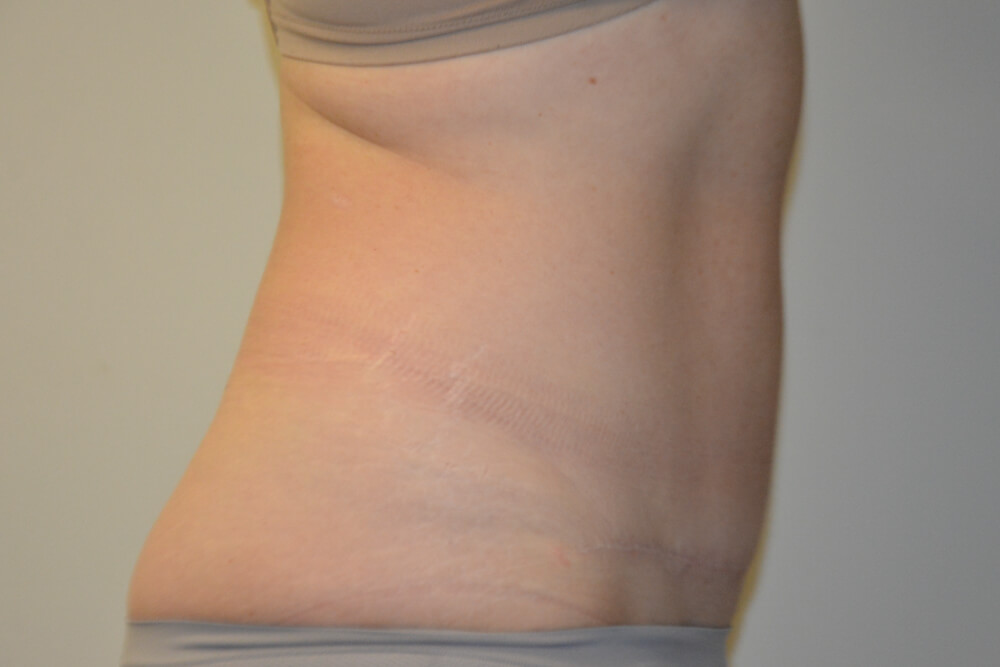 Tummy-Tuck-27 | After Tummy Tuck 2