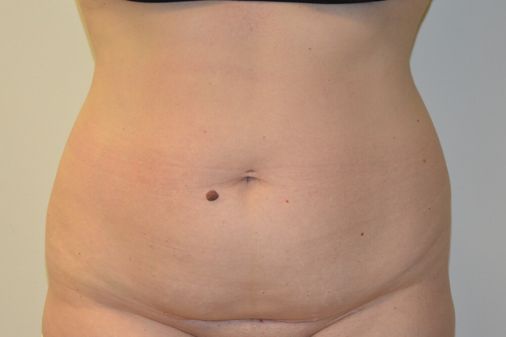 Tummy-Tuck-28 | Before Tummy Tuck