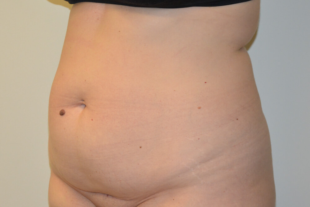 Tummy-Tuck-28 | Before Tummy Tuck 2