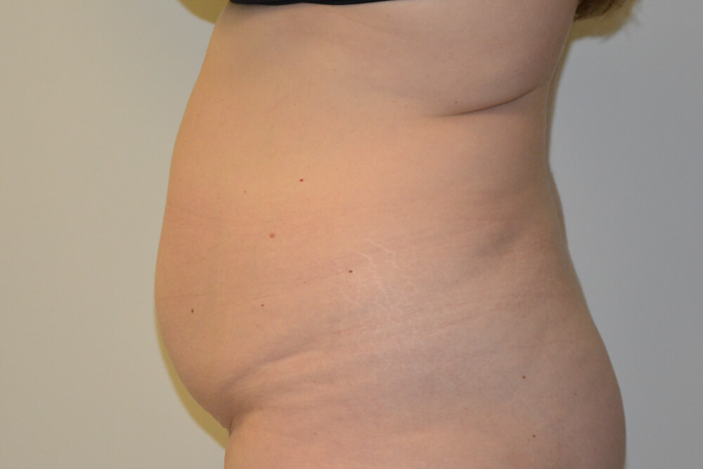 Tummy-Tuck-28 | Before Tummy Tuck 3