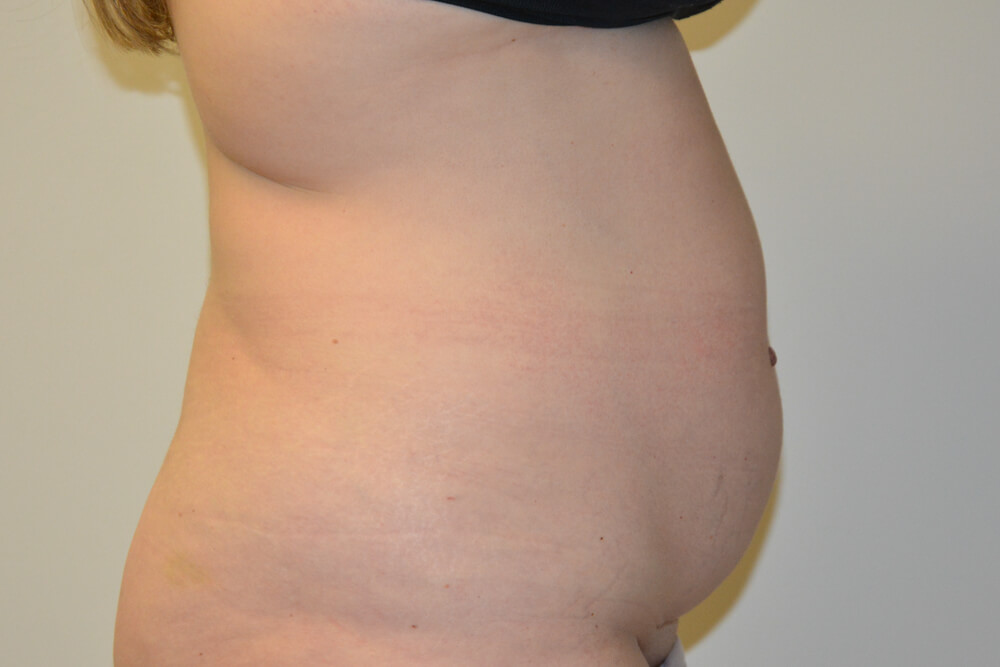 Tummy-Tuck-28 | Before Tummy Tuck 4