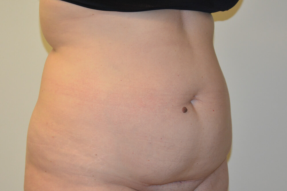 Tummy-Tuck-28 | Before Tummy Tuck 5
