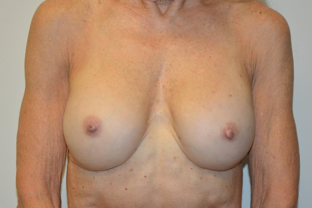 Breast-Revision-28 | After Breast Revision