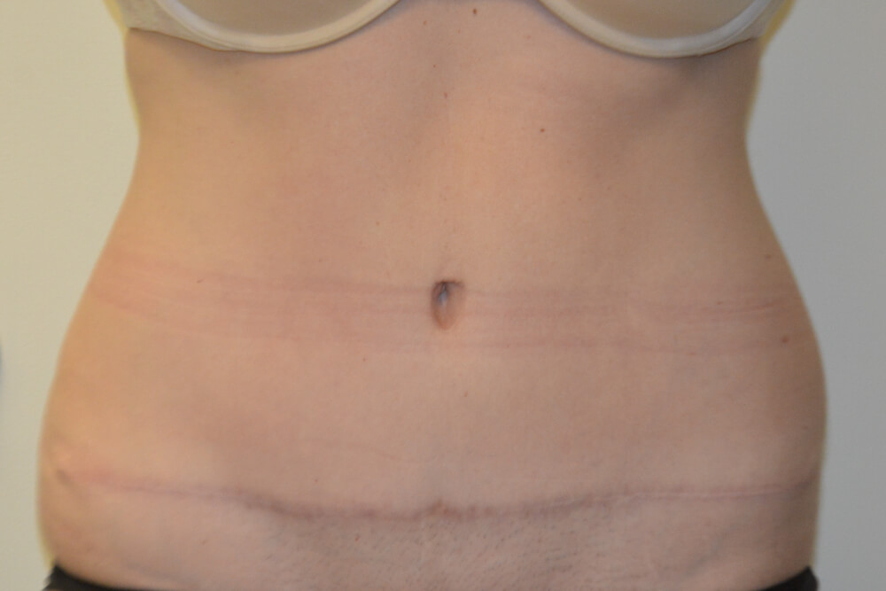 Tummy-Tuck-28 | After Tummy Tuck