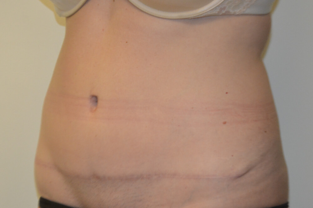 Tummy-Tuck-28 | After Tummy Tuck 2