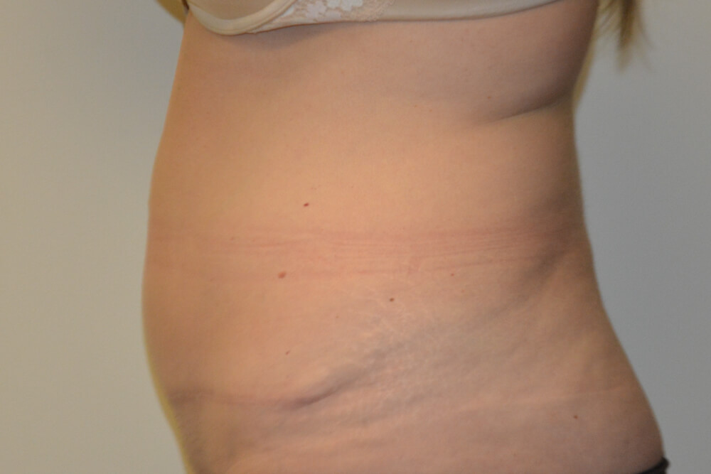 Tummy-Tuck-28 | After Tummy Tuck 3
