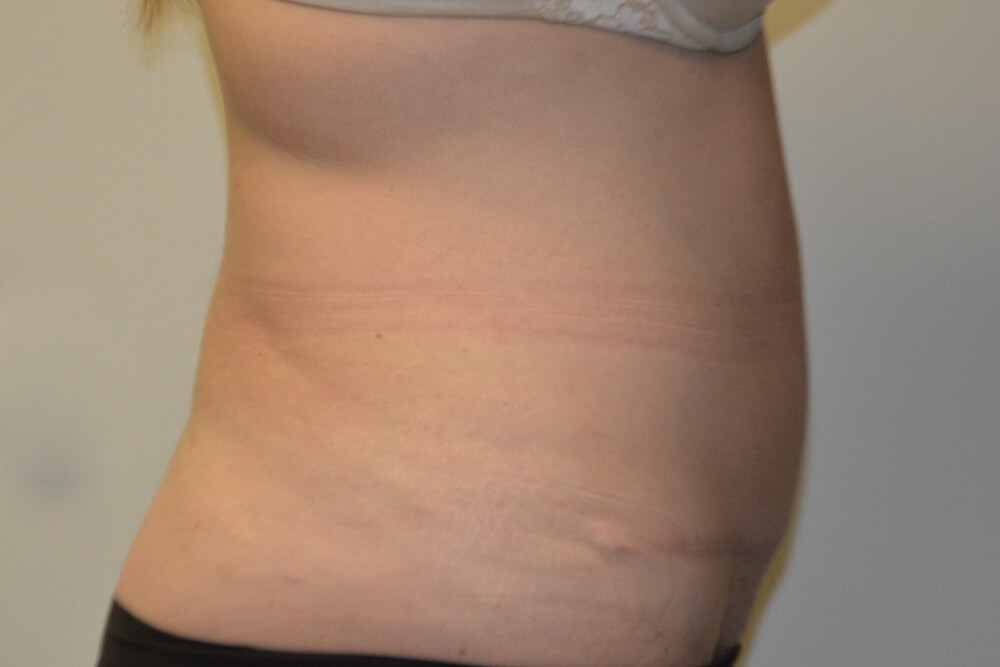 Tummy-Tuck-28 | After Tummy Tuck 4