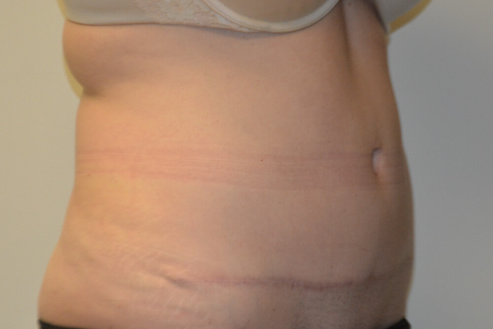 Tummy-Tuck-28 | After Tummy Tuck 5