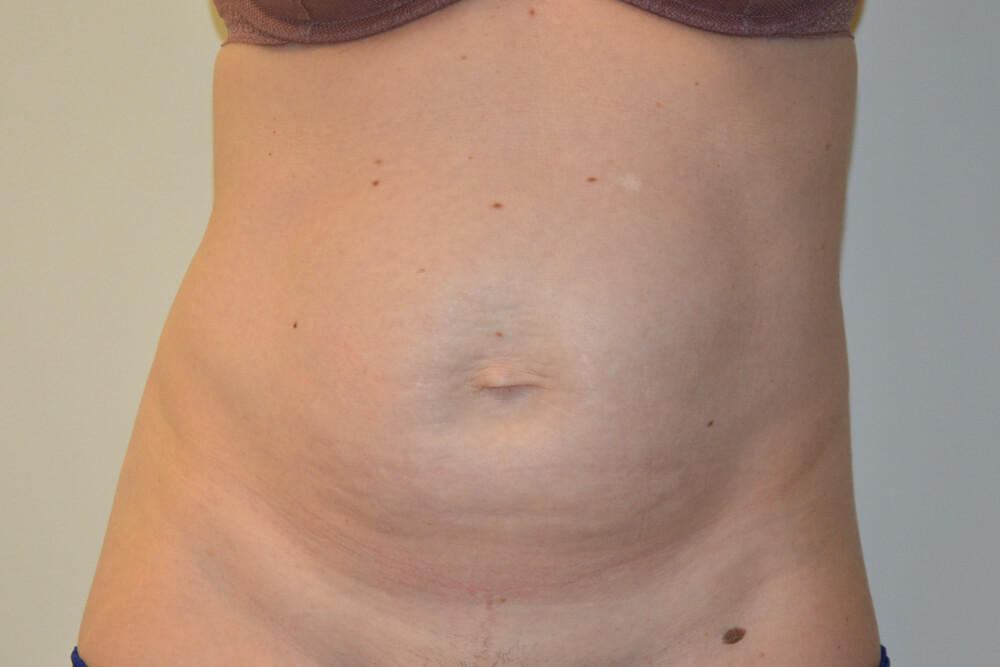 Tummy-Tuck-29 | Before Tummy Tuck