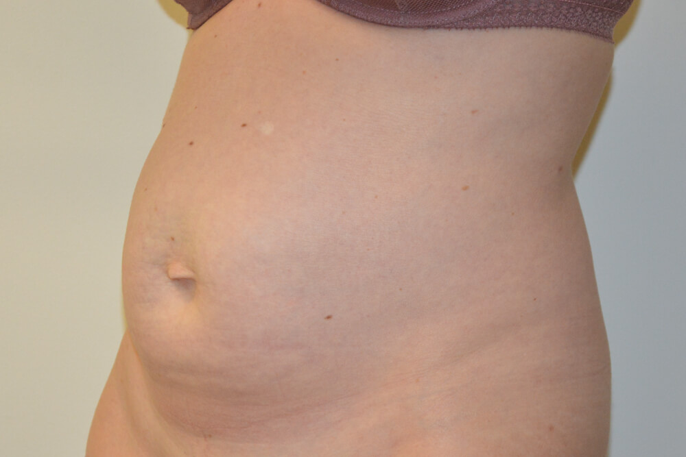 Tummy-Tuck-29 | Before Tummy Tuck 2