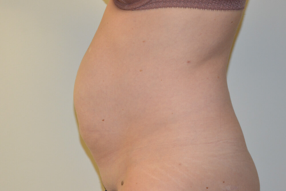 Tummy-Tuck-29 | Before Tummy Tuck 3