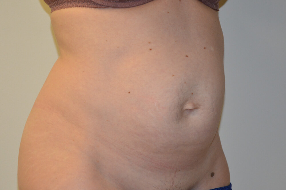Tummy-Tuck-29 | Before Tummy Tuck 4