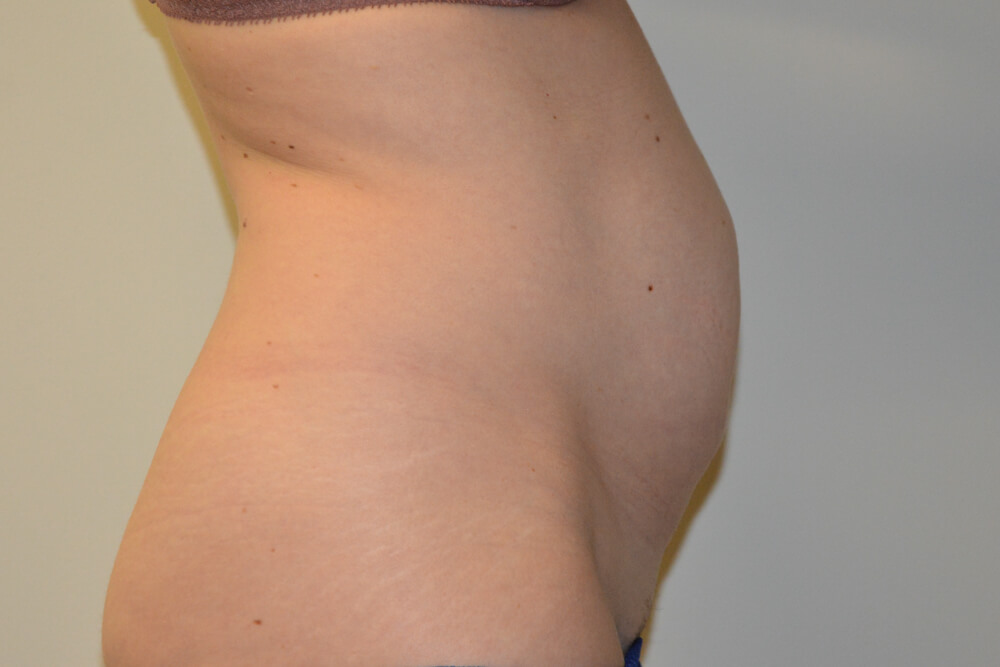 Tummy-Tuck-29 | Before Tummy Tuck 5