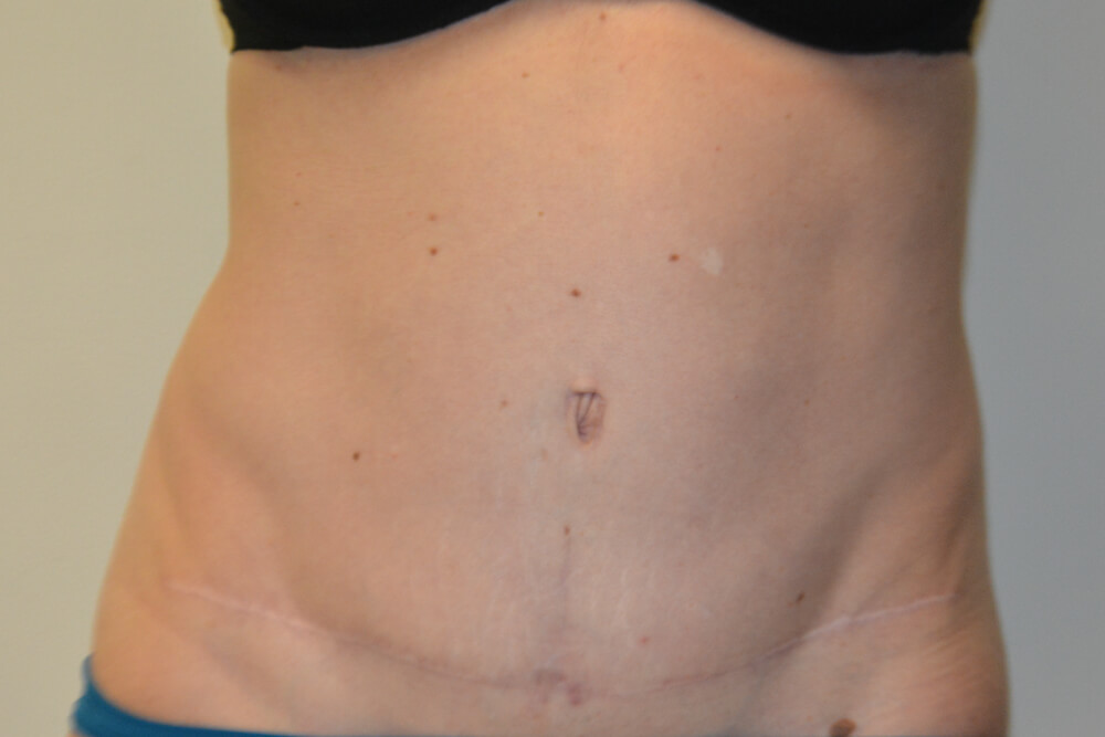 Tummy-Tuck-29 | After Tummy Tuck