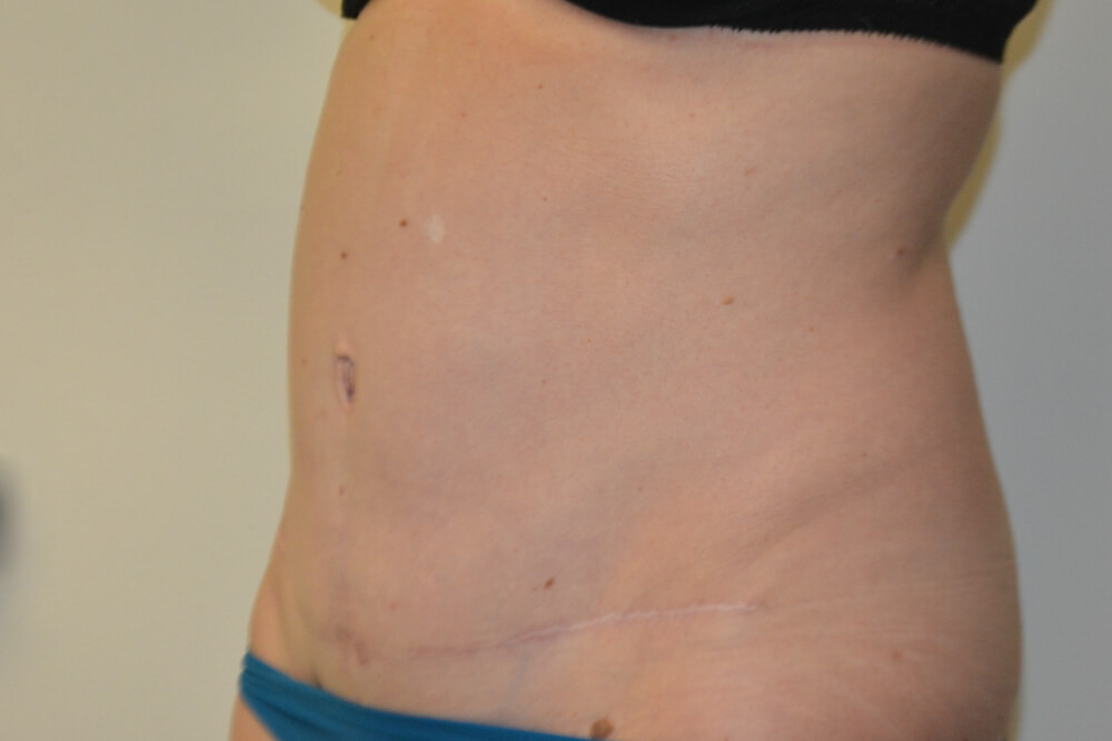 Tummy-Tuck-29 | After Tummy Tuck 2