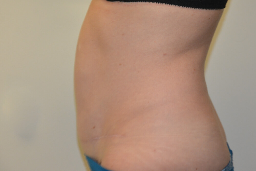 Tummy-Tuck-29 | After Tummy Tuck 3