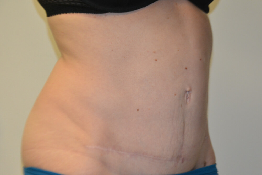 Tummy-Tuck-29 | After Tummy Tuck 4
