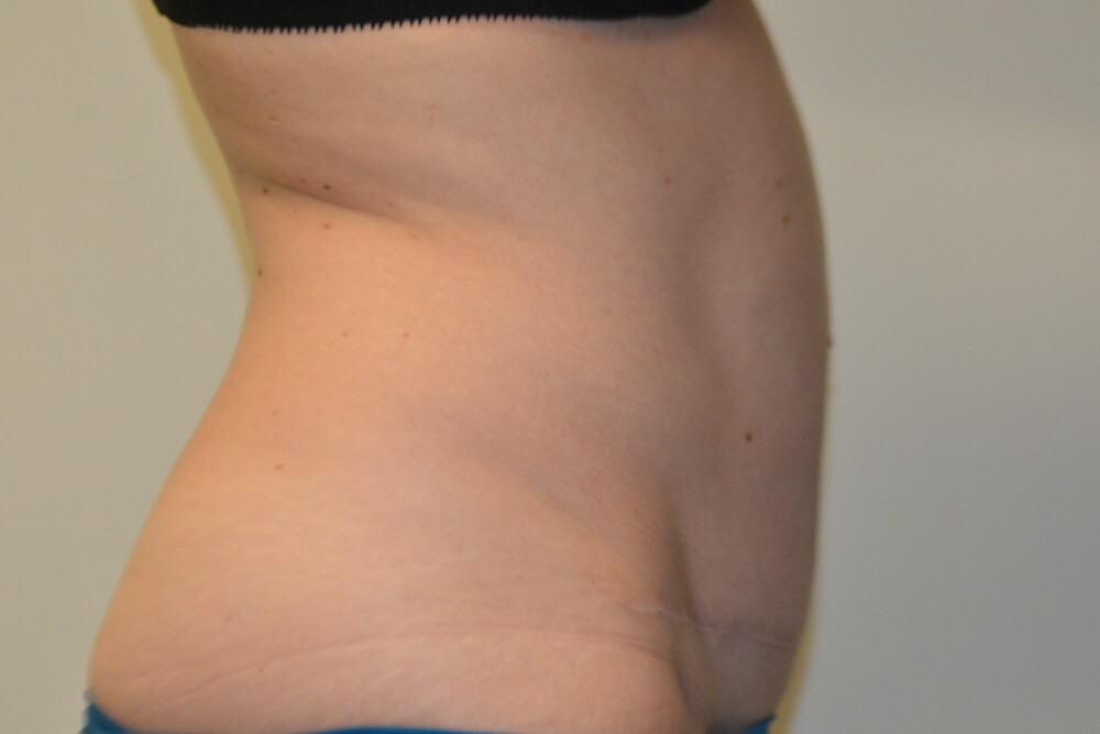 Tummy-Tuck-29 | After Tummy Tuck 5