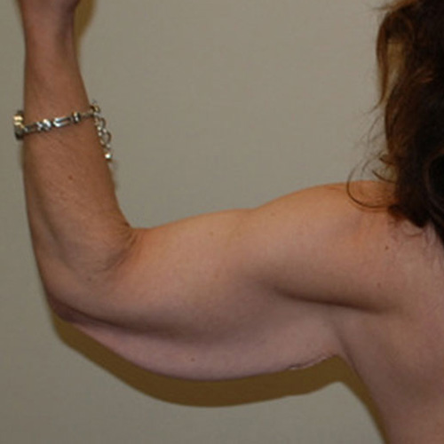 Arm-Lift-02 | Before Arm Lift 3