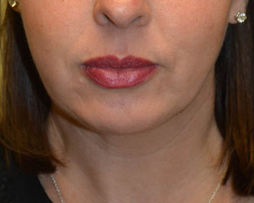 Chin-Augmentation-02 | After Chin Augmentation