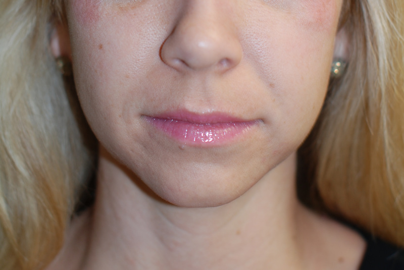 Neck-Liposuction-03 | After Neck Liposuction