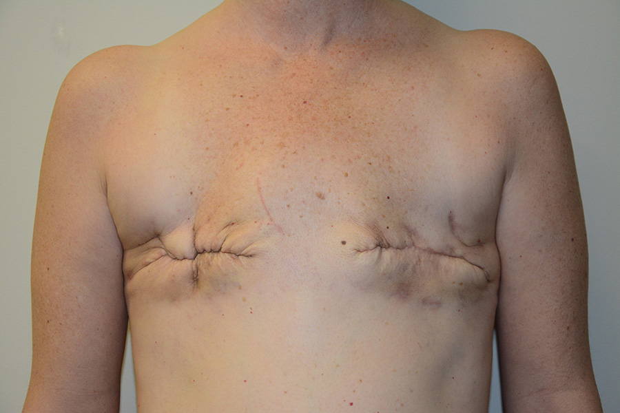Breast-Reconstruction-TRAM-Flap-02 | Before Breast Reconstruction TRAM Flap
