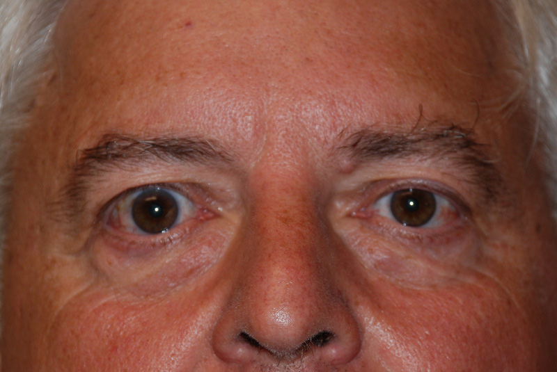Eyelid-Surgery-03 | Before Eyelid Surgery 1