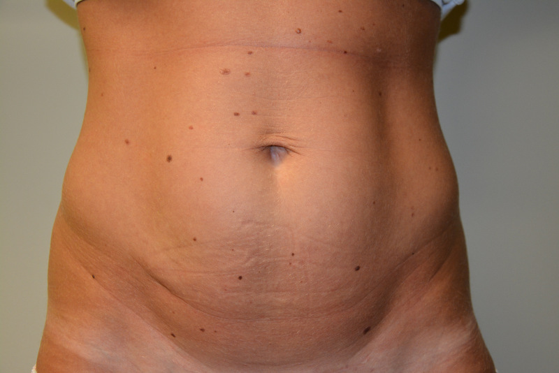 Mini-Tummy-Tuck-02 | Before Mini Tummy Tuck 1