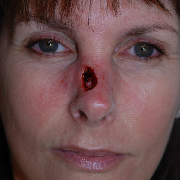 Skin-Cancer-Reconstruction-02 | Before Skin Cancer Reconstruction