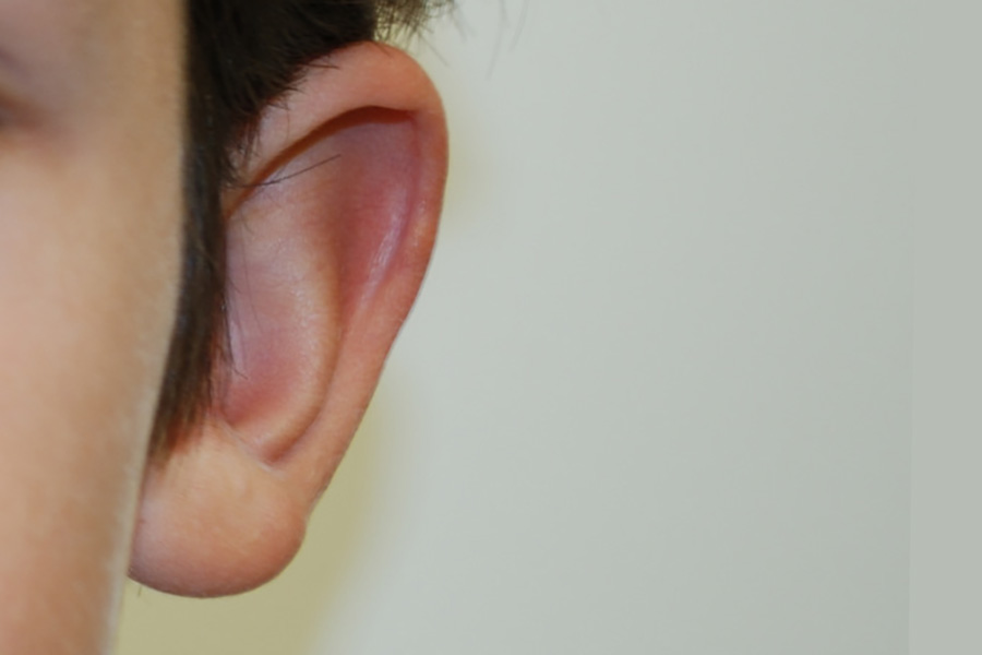 Prominent-Ear-Surgery-02 | Before Prominent Ear Surgery
