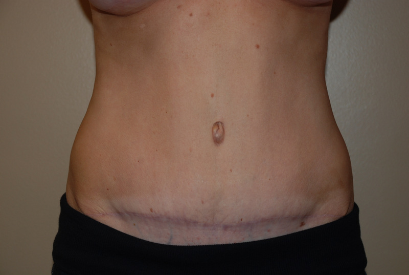 Tummy-Tuck-03 | After Tummy Tuck