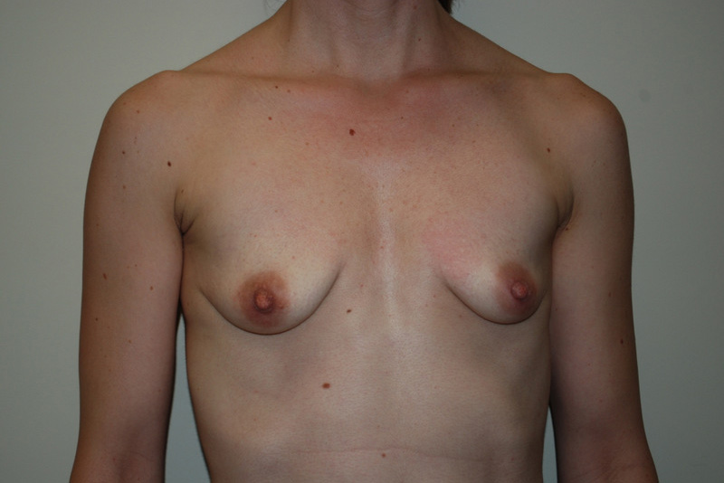 Breast-Revision-09 | Before Breast Revision