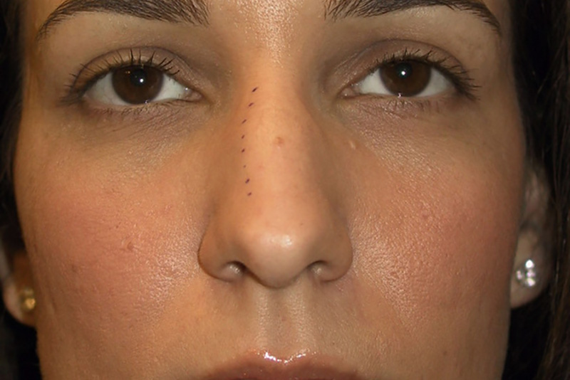 Rhinoplasty-02 | Before Rhinoplasty